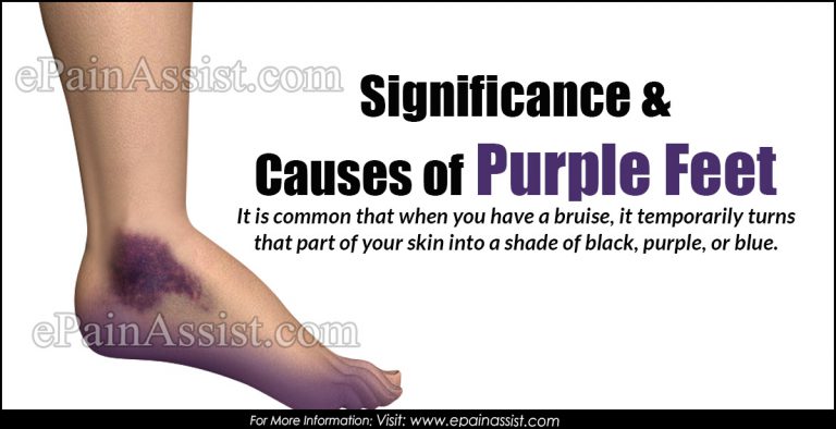 Significance & Causes of Purple Feet