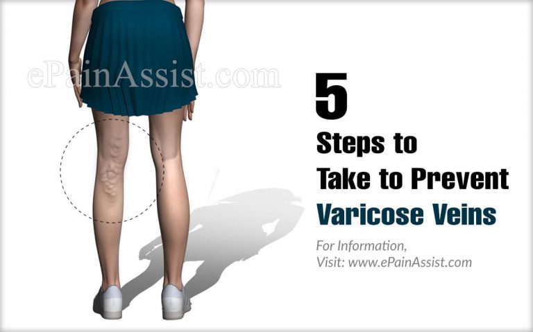 5 Steps to Take to Prevent Varicose Veins