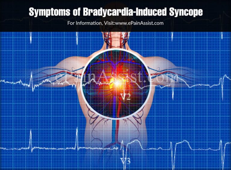 What is Bradycardia-Induced Syncope & How is it Treated?|Causes, Symptoms, Prevention of Bradycardia-Induced Syncope