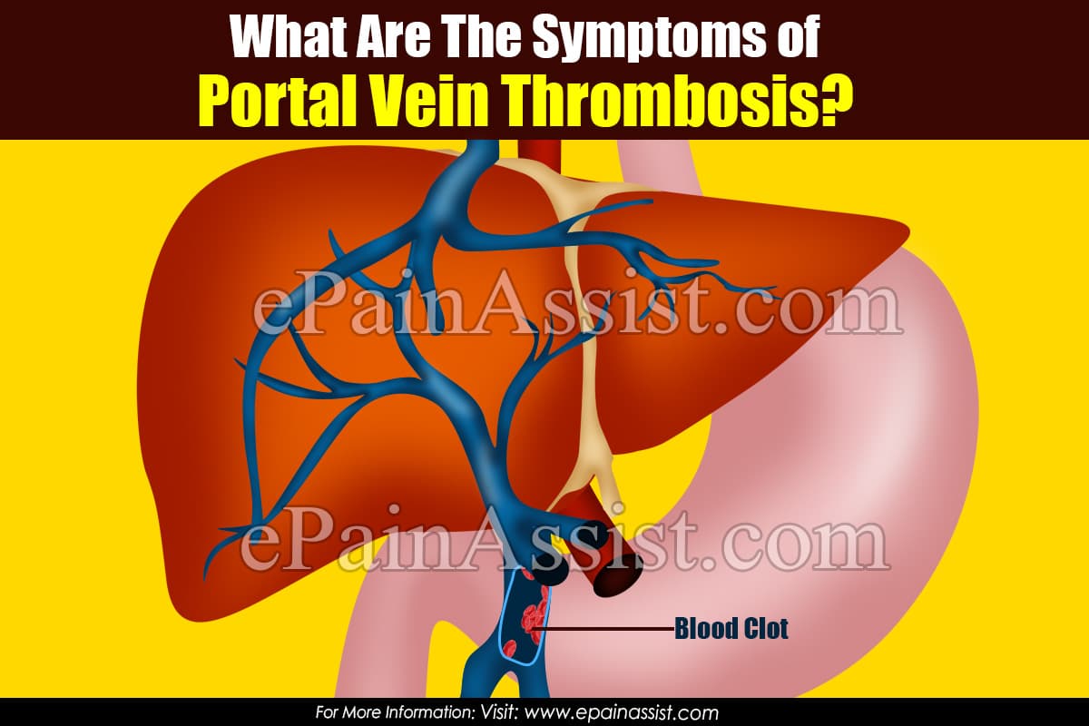 What Are The Symptoms of Portal Vein Thrombosis?