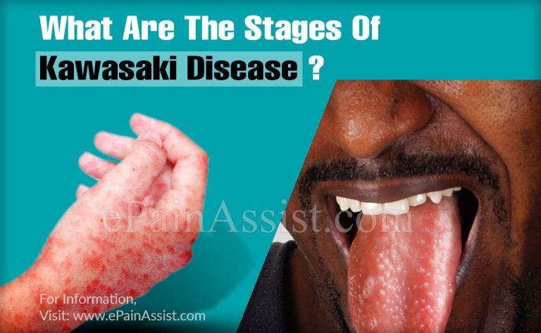 What Are The Stages Of Kawasaki Disease?