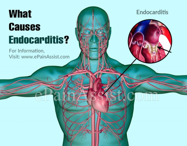 What Causes Endocarditis & How Is It Treated?