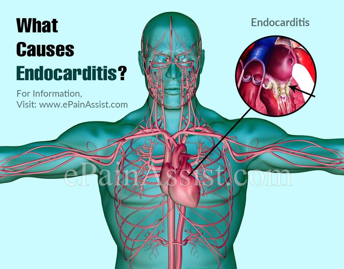 What Causes Endocarditis?