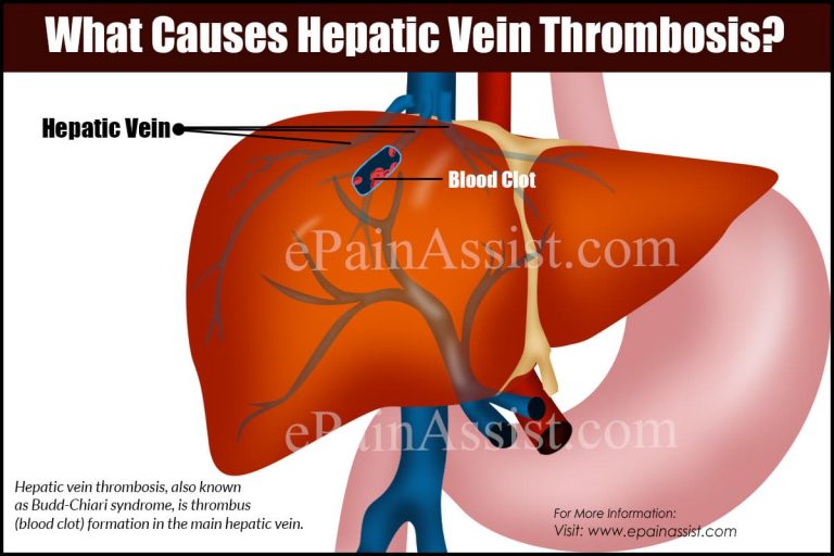 What Causes Hepatic Vein Thrombosis?