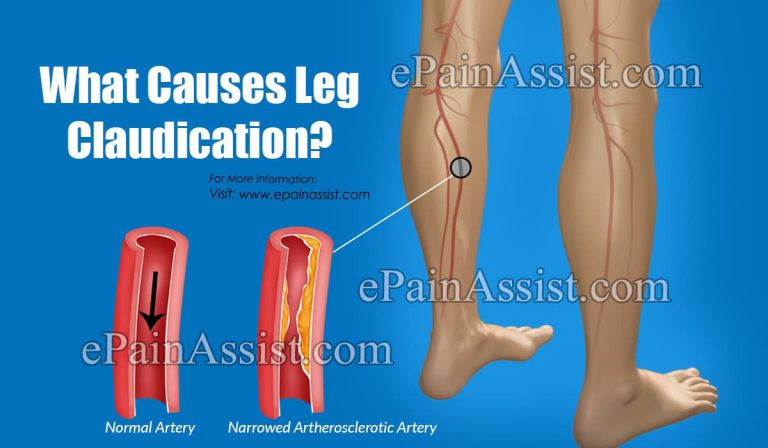 What Causes Leg Claudication?