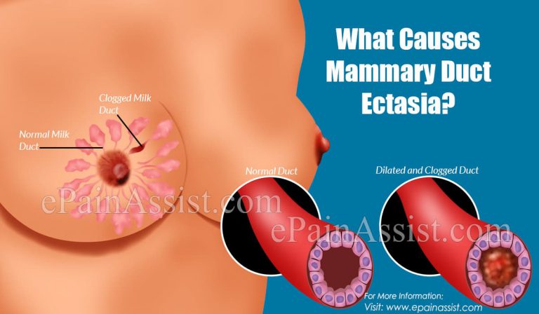 What Causes Mammary Duct Ectasia?