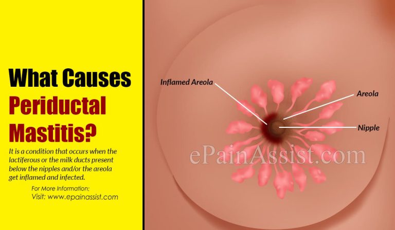 What Causes Periductal Mastitis?