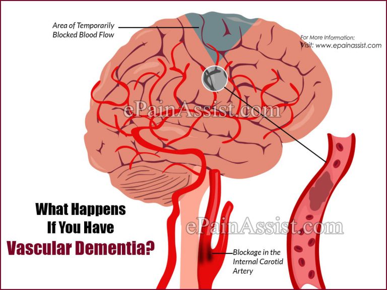 What Happens If You Have Vascular Dementia & What To Do For It?