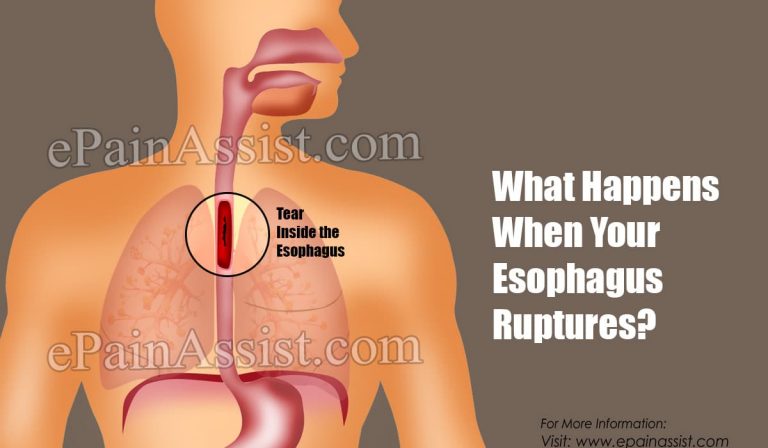 What Happens When Your Esophagus Ruptures & What To Do About It?