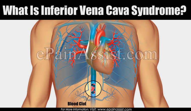Inferior Vena Cava Syndrome: Causes, Symptoms ,Treatment