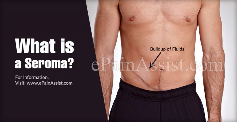 How to Identify a Seroma & Can Seromas Cause Complications?
