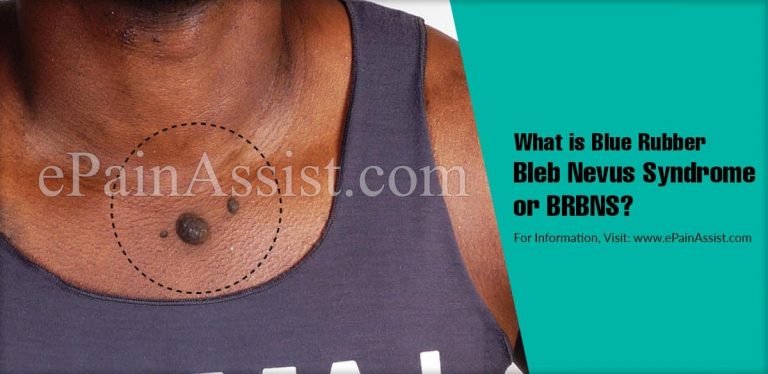 What is Blue Rubber Bleb Nevus Syndrome & How is it Treated?| Causes, Symptoms, Treatment, Epidemiology, Diagnosis of BRBNS