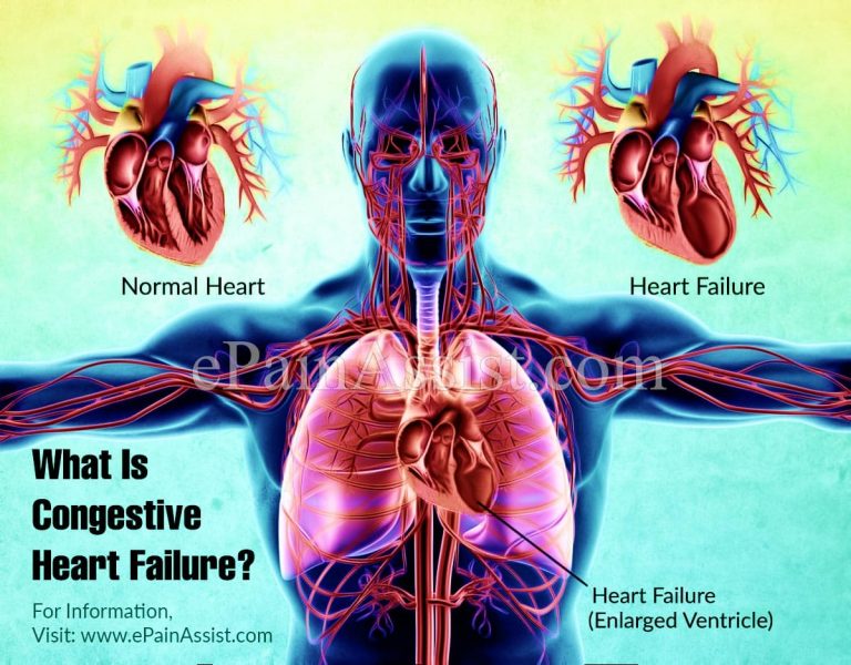 What is Congestive Heart Failure: Types, Causes, Symptoms, Treatment, Prognosis, Diagnosis