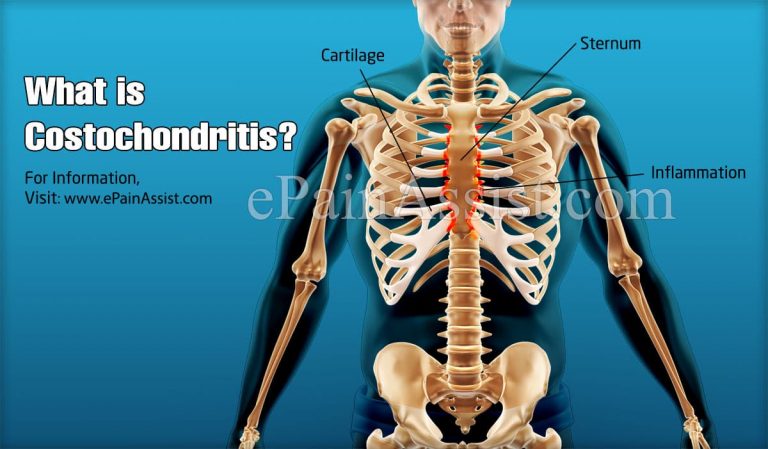 What is Costochondritis  & How is it Treated?: Causes, Symptoms, Diagnosis of Costochondritis