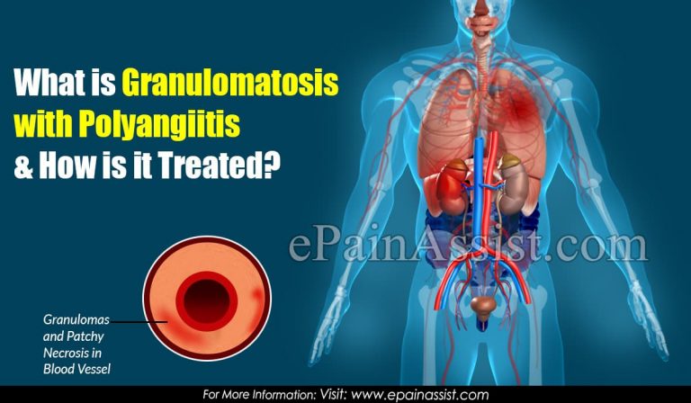 What is Granulomatosis with Polyangiitis & How is it Treated? Causes, Symptoms, Prognosis of Granulomatosis Polyangiitis