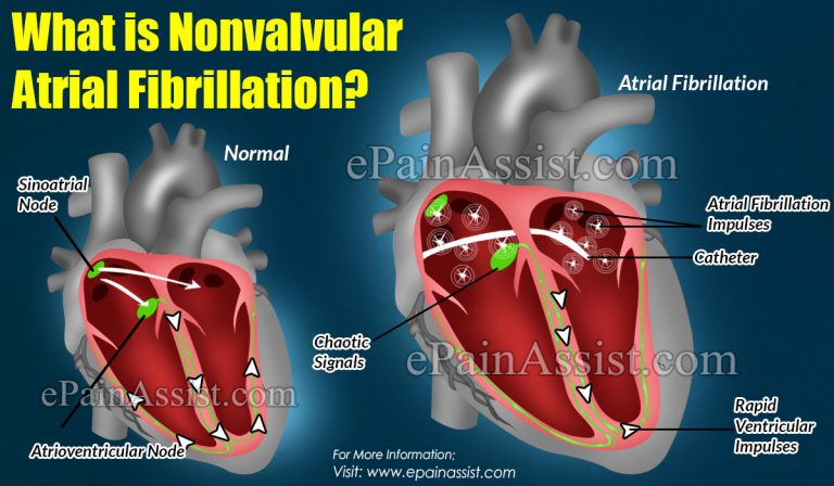 What Is Nonvalvular Atrial Fibrillation: Causes, Symptoms, Treatment, Surgery, Prognosis