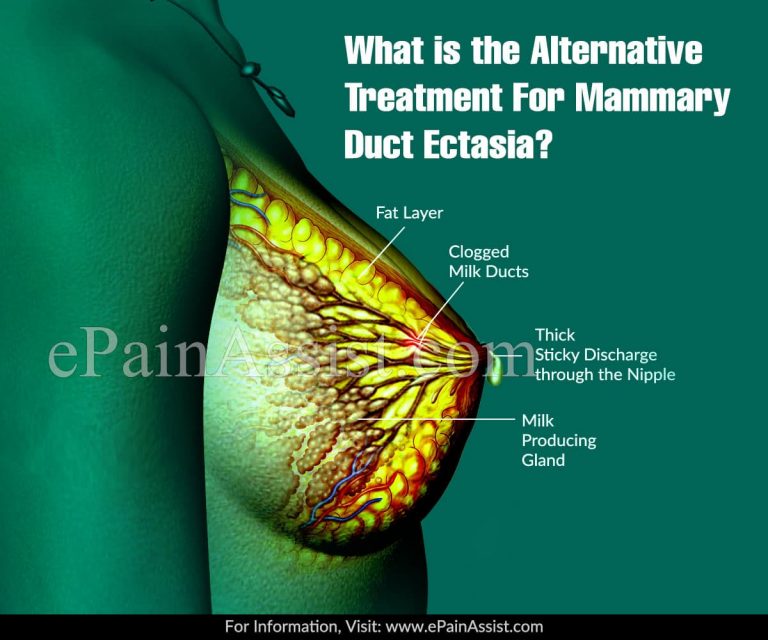 What is the Alternative Treatment For Mammary Duct Ectasia?
