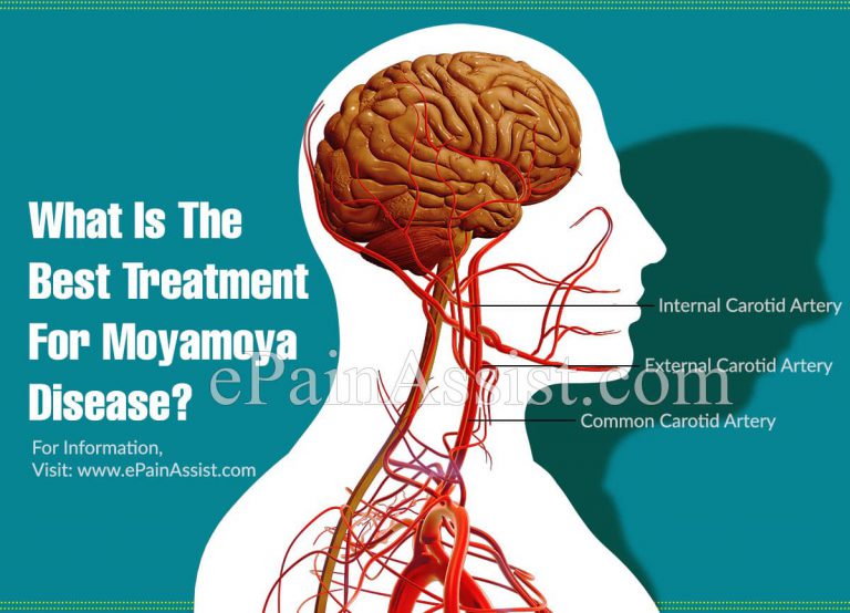 What Is The Best Treatment For Moyamoya Disease?