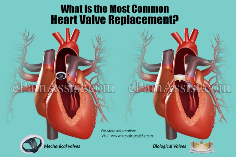 What is the Most Common Heart Valve Replacement?
