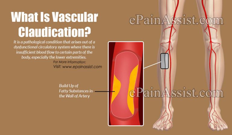 What is Vascular Claudication: Causes, Symptoms, Treatment, Diagnosis