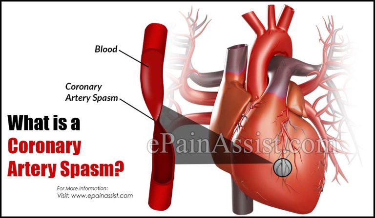 Coronary Artery Spasm: Causes, Symptoms, Treatment, Complications