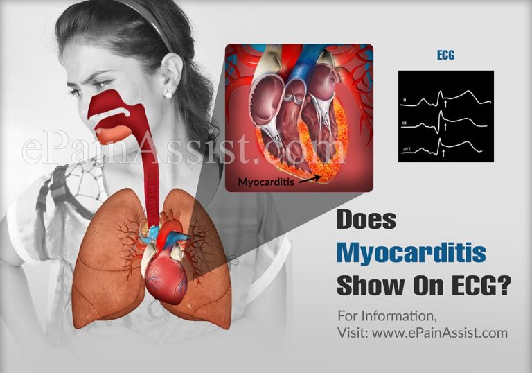 Does Myocarditis Show On ECG?