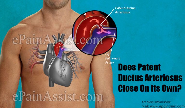 Does Patent Ductus Arteriosus Close On Its Own & What Are Its Natural Remedies?