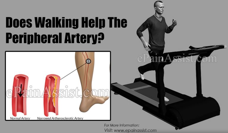Does Walking Help Peripheral Artery & Do Compression Socks Help?