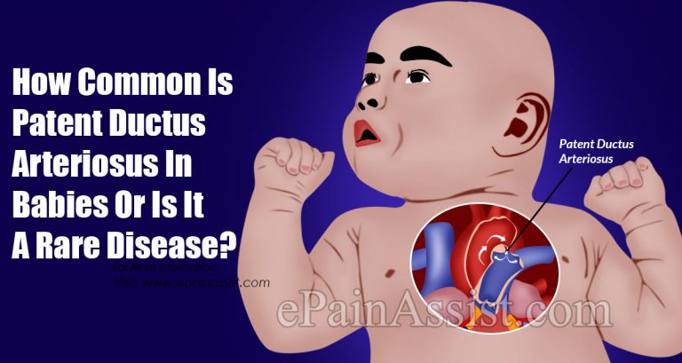 How Common Is Patent Ductus Arteriosus In Babies Or Is It A Rare Disease?