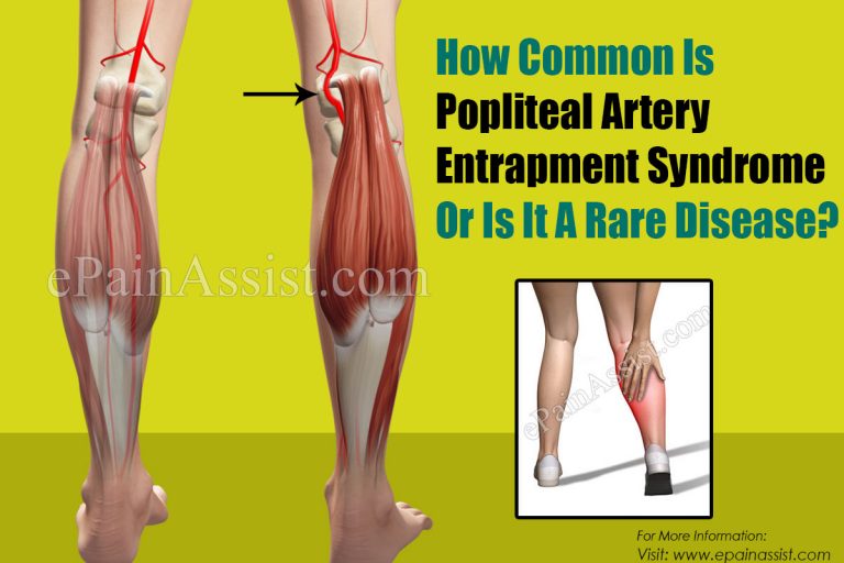 How Common Is Popliteal Artery Entrapment Syndrome Or Is It A Rare Disease?