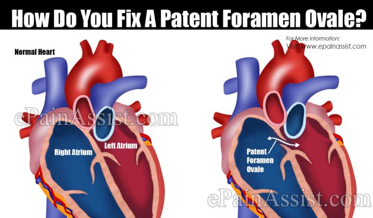 How Do You Fix A Patent Foramen Ovale & Can PFO Cause A Heart Attack?