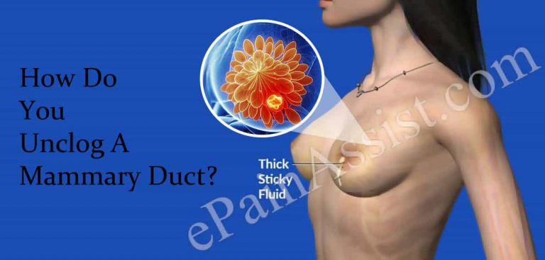 How Do You Unclog A Mammary Duct?