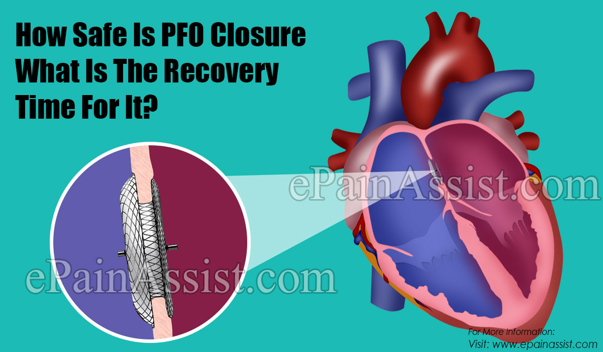 How Safe Is PFO Closure What Is The Recovery Time For It?