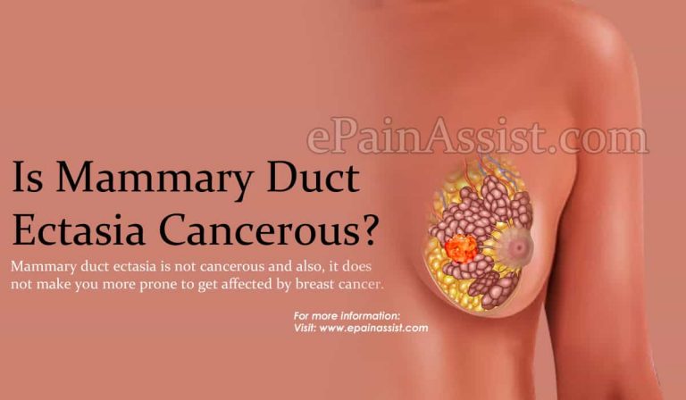 Is Mammary Duct Ectasia Cancerous?