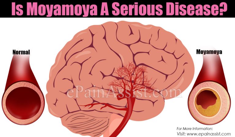 Is Moyamoya A Serious Disease?