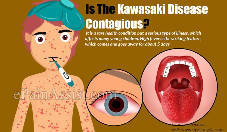 Is The Kawasaki Disease Contagious?