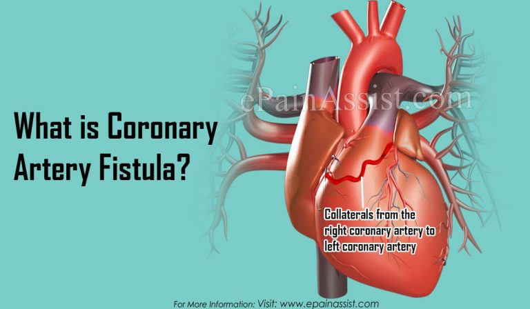 What is Coronary Artery Fistula, Know its Causes, Symptoms, Complications and Diagnosis