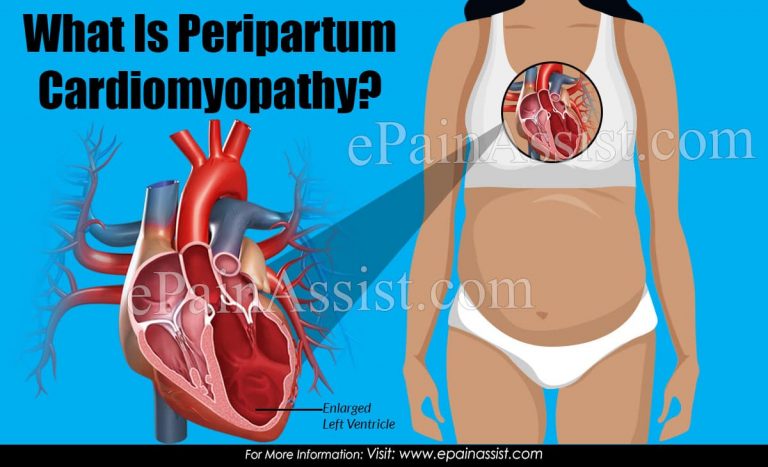 What is Peripartum Cardiomyopathy: Causes, Symptoms, Treatment, Prognosis