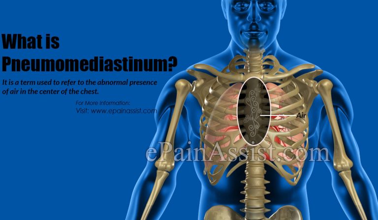 What is Pneumomediastinum & How is it Treated? | Causes, Symptoms and Diagnosis of Pneumomediastinum