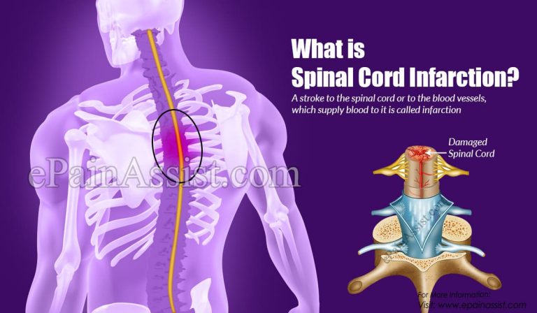 What is Spinal Cord Infarction: Symptoms, Causes, Treatment, Complications, Diagnosis