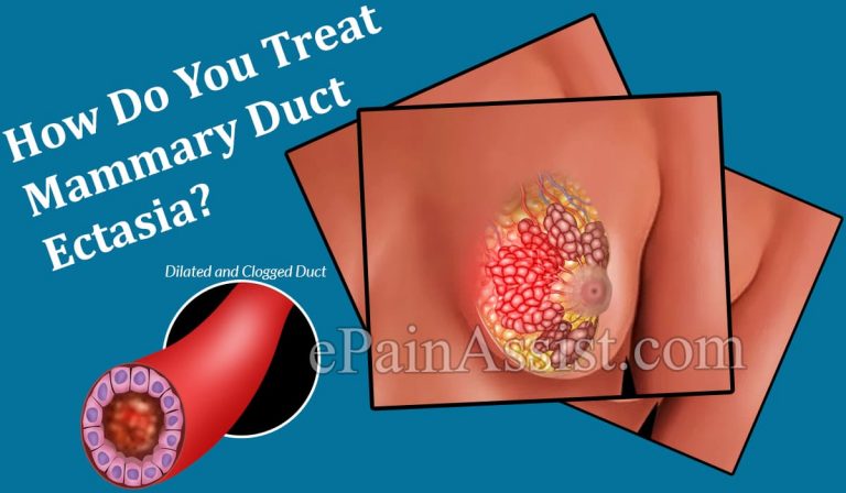 How Do You Treat Mammary Duct Ectasia?