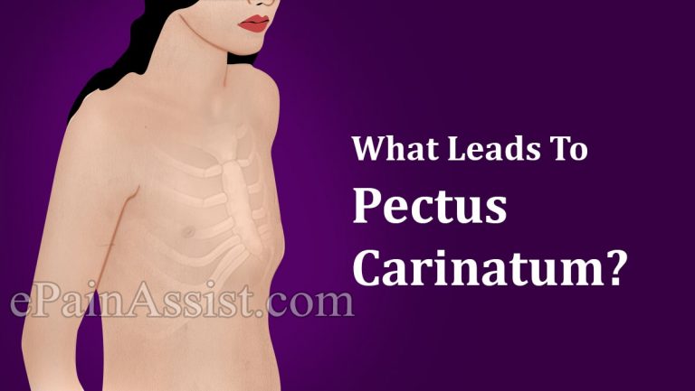 What Leads To Pectus Carinatum & Can It Be Cured?
