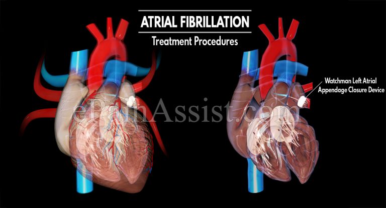 Atrial Fibrillation Treatment Procedures