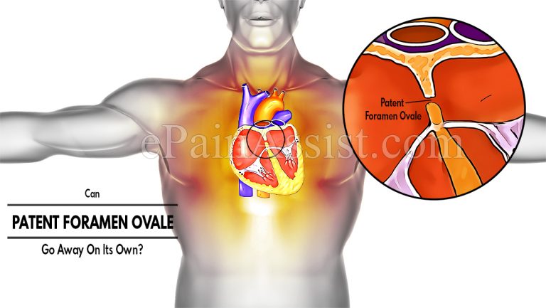 Can Patent Foramen Ovale Go Away On Its Own & What Are Its Natural Remedies?