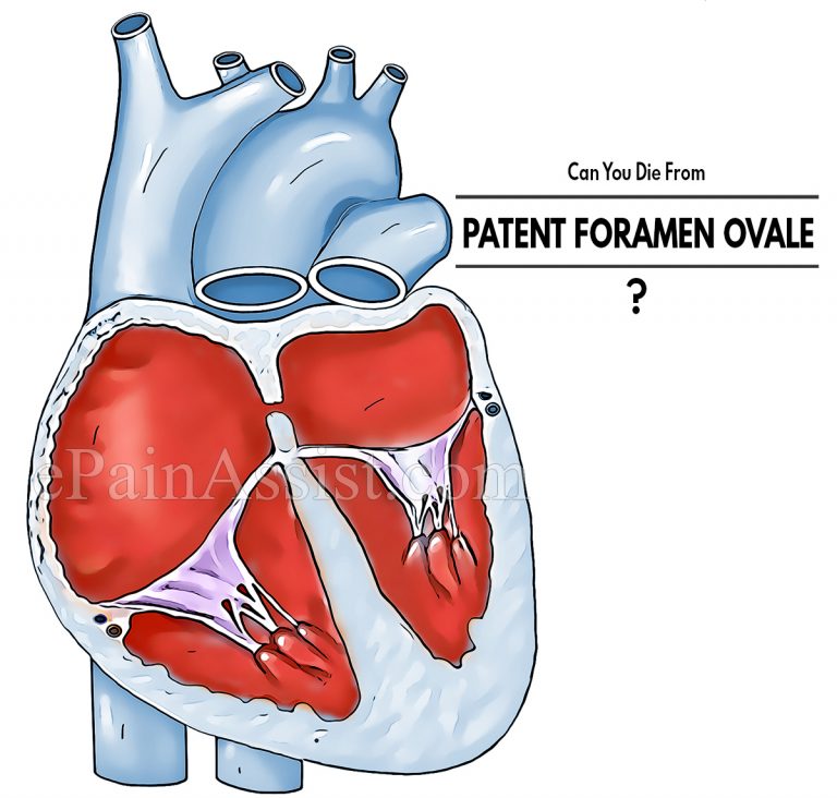 Can You Die From Patent Foramen Ovale & How Does It Affect The Body & What Triggers It?