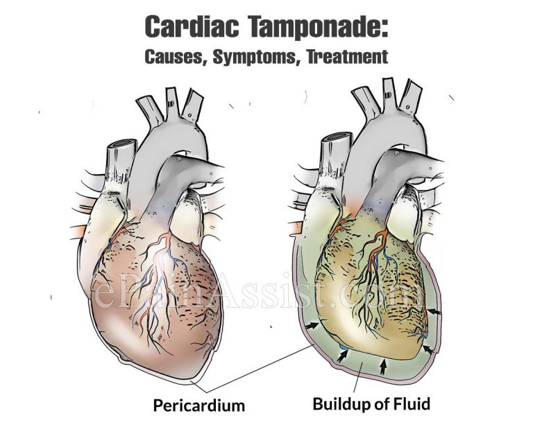 Cardiac Tamponade: Causes, Symptoms, Treatment
