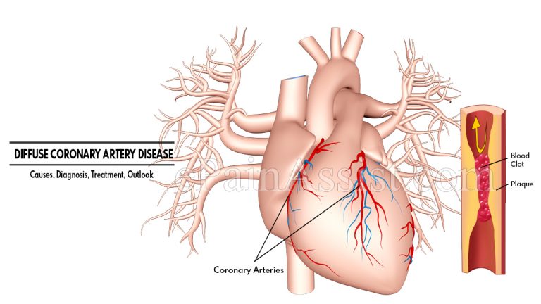 Diffuse Coronary Artery Disease : Causes, Diagnosis, Treatment, Outlook