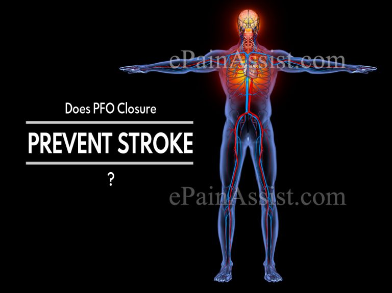 Does PFO Closure Prevent Stroke & Are You Awake During A PFO Closure & How Much Does It Cost?