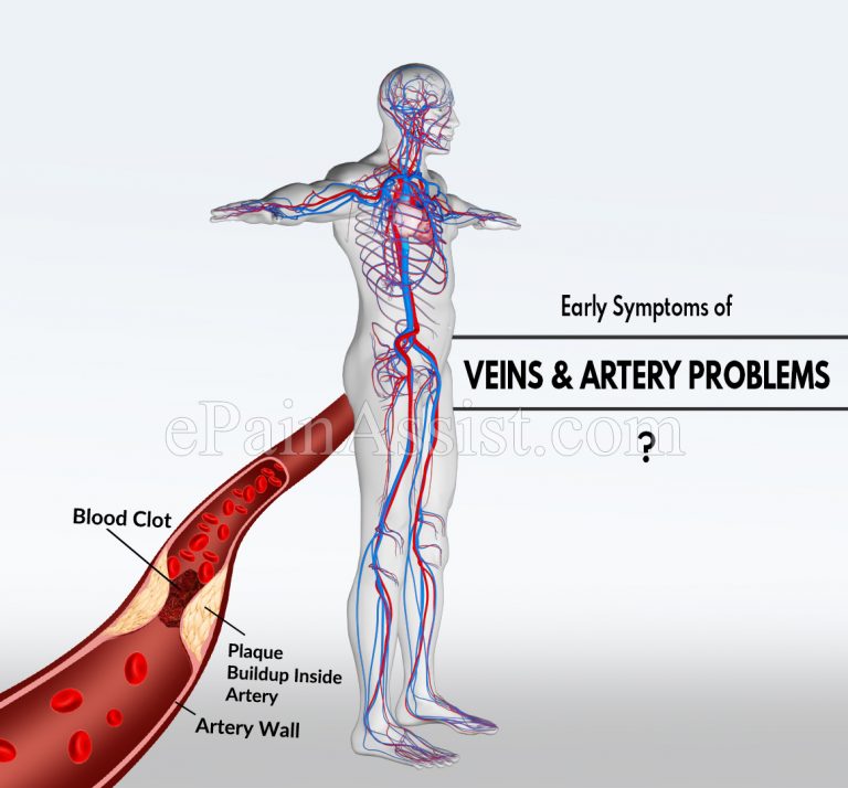 Early Symptoms of Veins and Artery Problems and What Condition They Cause