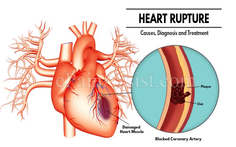 Heart Rupture- Causes, Diagnosis and Treatment